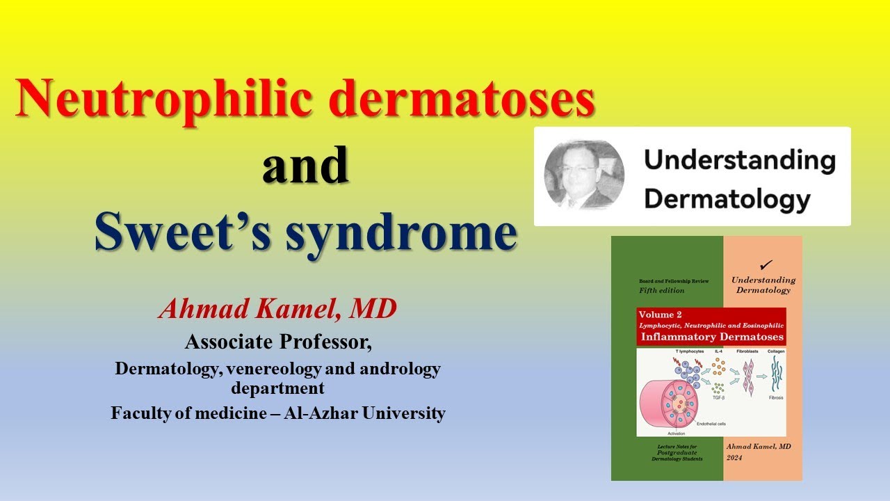 Neutrophilic Dermatoses and Sweet’s Syndrome