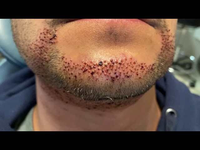 Dallas Beard-to-Beard FUE Hair Transplant Close-up One Day Out