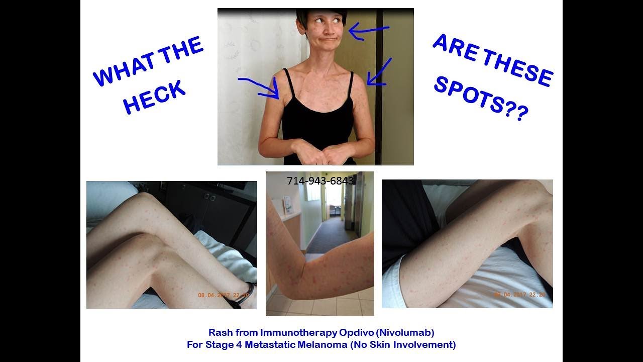 WHAT ARE THESE SPOTS? IMMUNOTHERAPY NIVOLUMAB RASH? YouTube