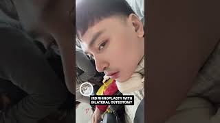 Nose reveal one month post IRD RHINOPLASTY with Bilateral Osteotomy #DrShimmian
