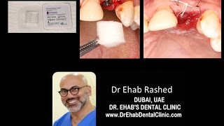 PiezoSurgery Tooth Extraction Technique at Dr.Ehab's Dental Clinic, Dubai
