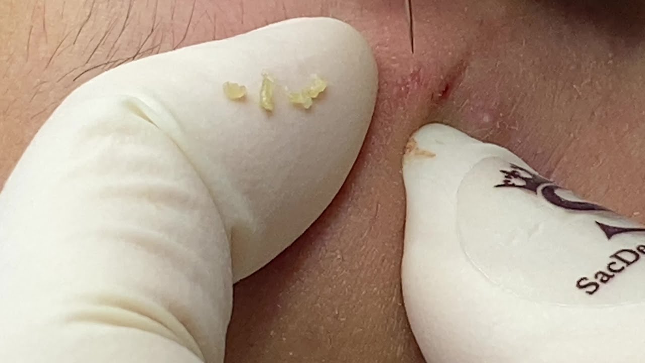 Blind Pimple Under the Skin | Mụn Dưới Da - SacdepSpa#154