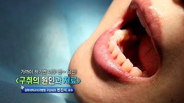 구취의 원인과 치료 - 경북대치과병원 구강내과 변진석 교수