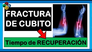 FRACTURA de cubito REHABILITACIÓN | TIEMPO de RECUPERACIÓN FRACTURA de cubito REHABILITACIÓN | TIEMPO de RECUPERACIÓN