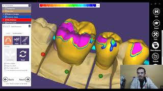 posterior bridge exocad شرح بالعربي screenshot 5