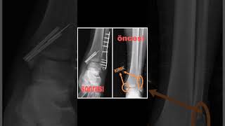 Medial Malleol , Lateral Malleol Kırığı Ameliyatı ( Platin Takma Ameliyatı )  Ve İyileşme Sürecim Resimi