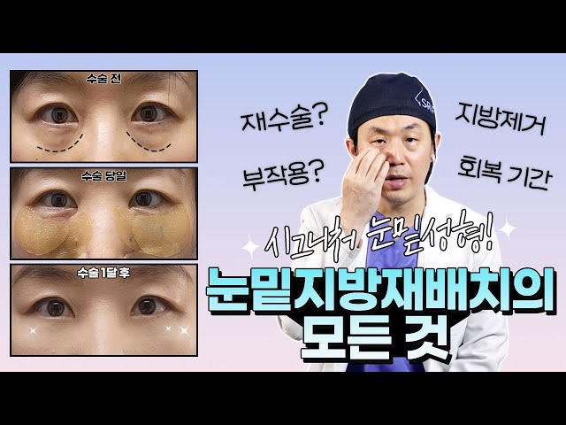 👀눈밑지방재배치의 모든 것!🙂 (부작용, 지방제거, 회복 기간❔  Q&A 총정리)