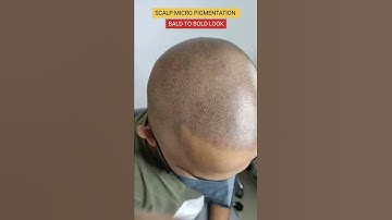 Bye Bye Baldness,Best scalp micro Pigmentation now in kerala#cochin  8891426652,8078800335 #smp