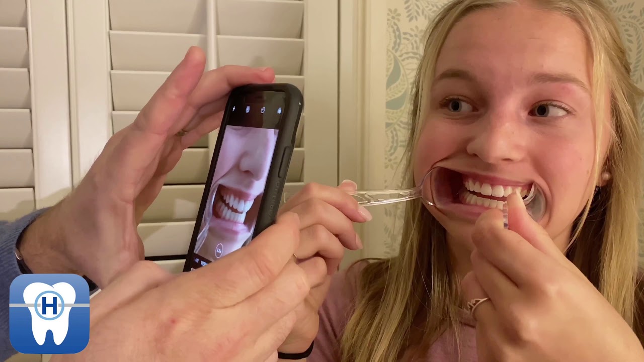 Easton Braces Virtual Consultation Photos