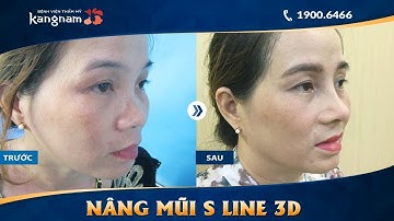 Nâng mũi S Line 3D + Cắt cánh mũi sau 1 tháng