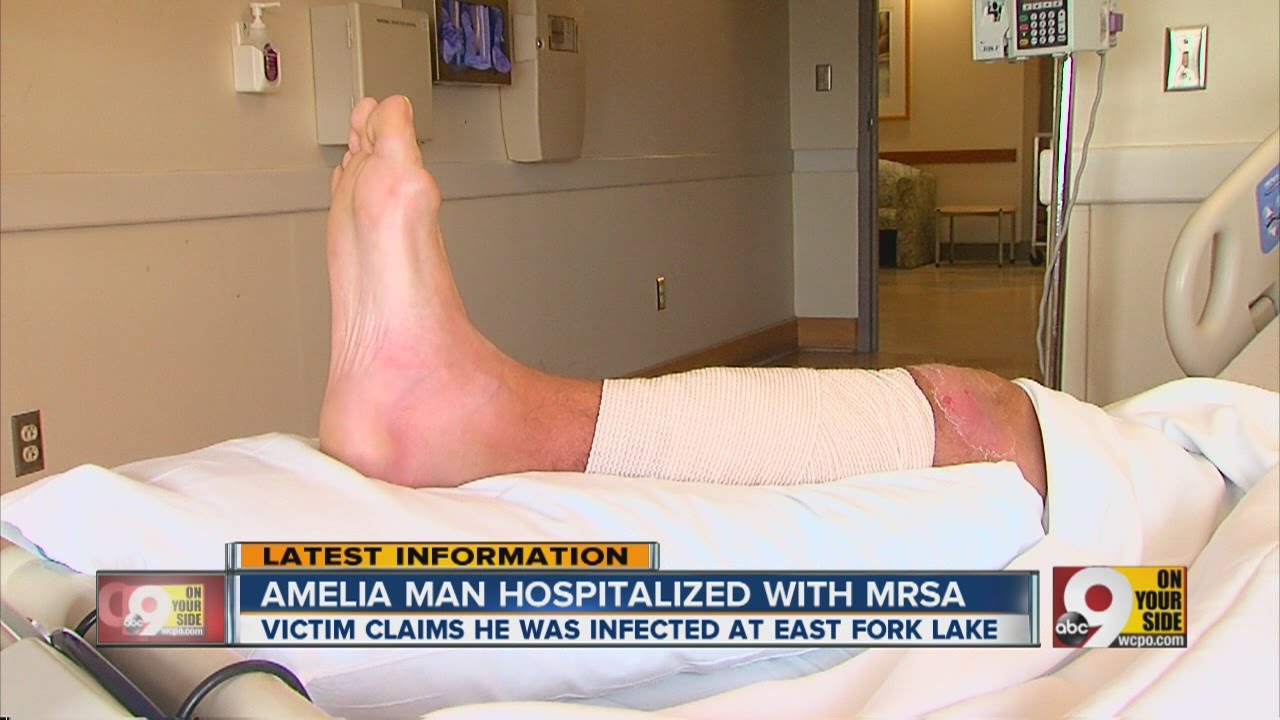 Amelia man hospitalized with MRSA