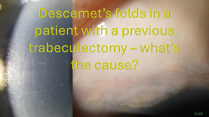 0126: Descemet's folds in a patient with a previous trabeculectomy