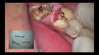 custom castpost post endodontic restoration