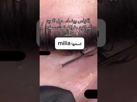 الحب الأبيض حاولين العين دي حبوب الميليا ودي الطريقة الوحيدة للتخلص منها حبوب ميليا