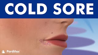 Cold Sores - Causes And Symptoms Of Herpes On Lip 8K