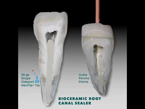 Delivering MTApex™ bioceramic root canal sealer