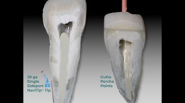 Delivering MTApex™ bioceramic root canal sealer