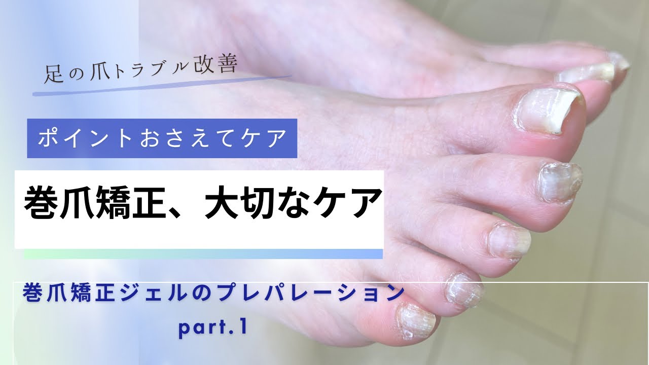 Ingrown Toenail Correction Gel [Foot Care Edition]: A video on