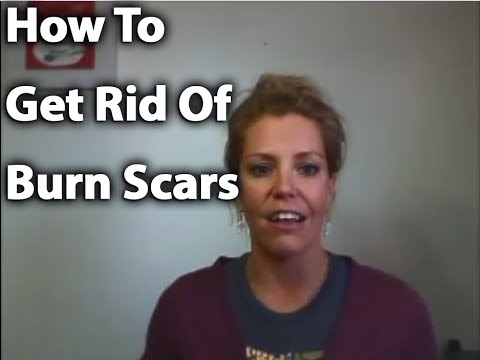 How To Get Rid of Burn Scars - YouTube