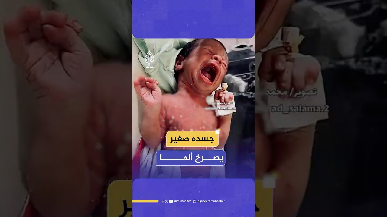 مشهد صعب لرضيع فلسطيني حديث الولادة وعلى جسده أعراض مرض جلدي نتيجة نقص الدواء