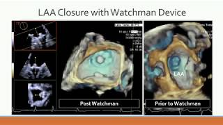 Echocardiography Fluoroscopy Fusion Imaging - Watchman Procedure & Mitral Paravalvular Leak Closure
