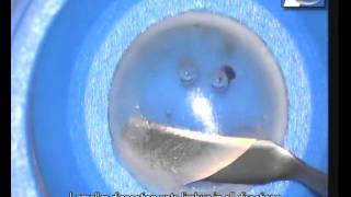 Manual Technique Of Donor Preparation In Endothelial Keratoplasty