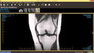 How to Read Knee MRI