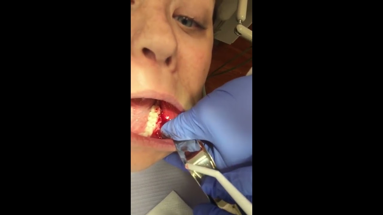 Tooth Abscess Drained - YouTube