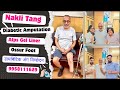 🥵😱Diabetic Amputation | Alps Gel Liner | Cusion Liner | Nakli Tang | Amputation in Delhi | #ossur