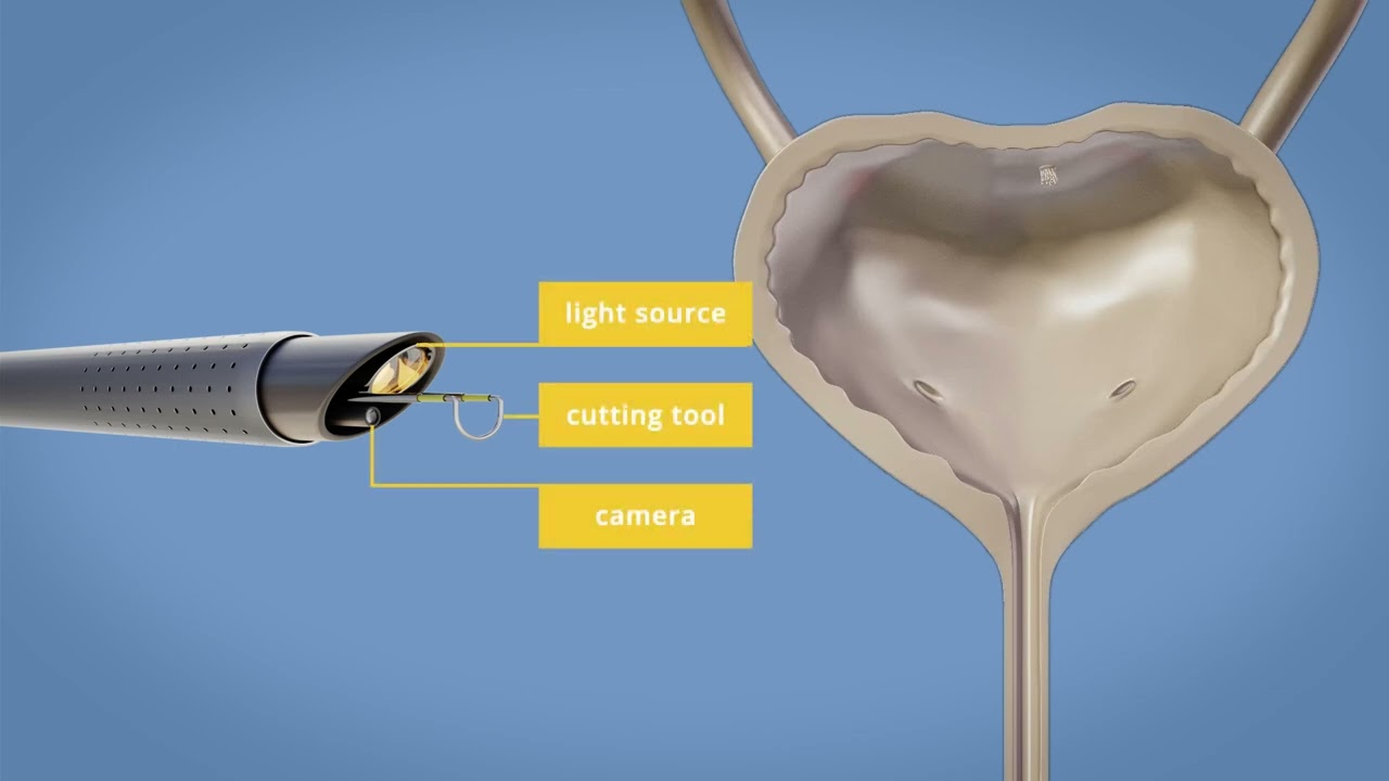TURBT Procedure: Transurethral Resection of Bladder Tumor for Cancer Treatment