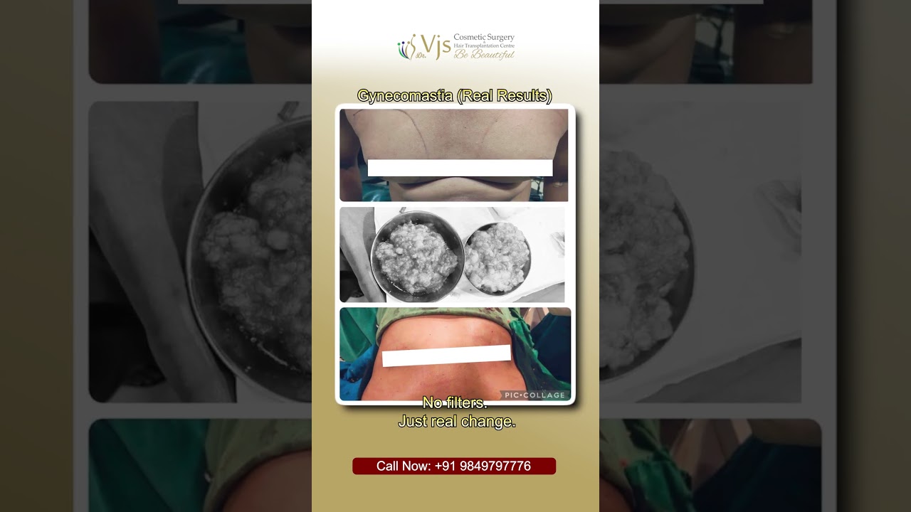 From Hiding to Confidence | Gynecomastia Treatment Vizag | What Really Changed?