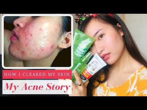 MY ACNE STORY | Budget Skincare for Acne Prone Skin (Philippines)