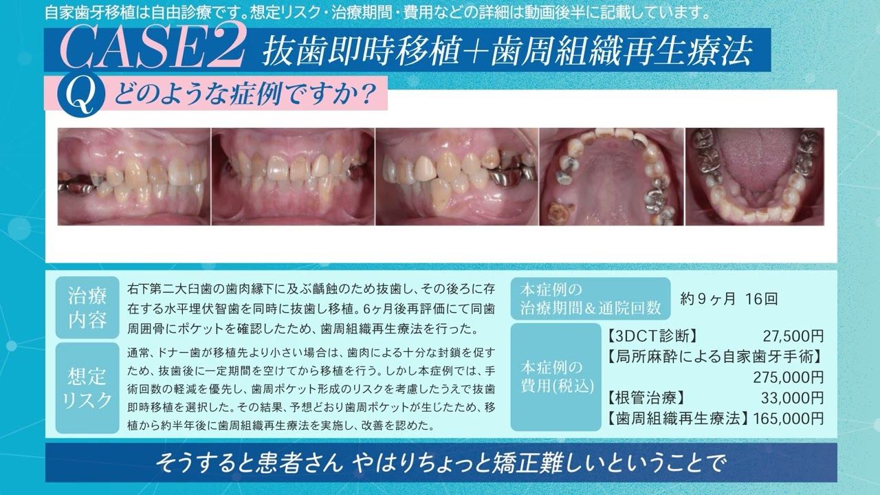 自家歯牙移植（歯の移植） | 学芸大学の歯科クリニック・歯科 | 健造