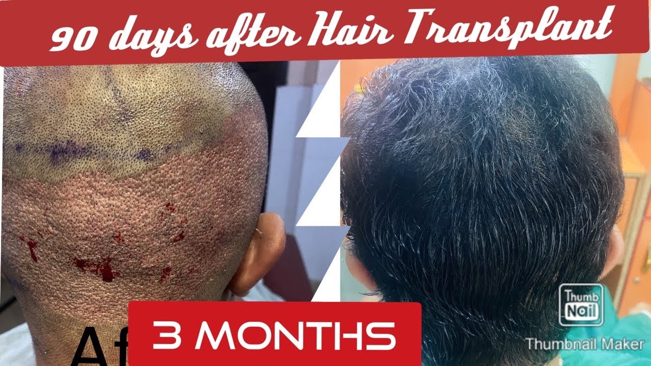 3 months hair Transplant Result pictures|day by day growth pictures