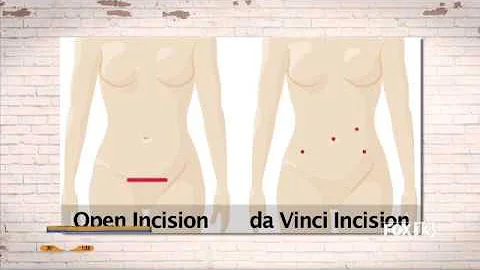 Laparoscopy vs. Open Incisions - Dr. Stephanie Hen...
