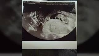 18 And Pregnant // Pregnancy announcement ♡