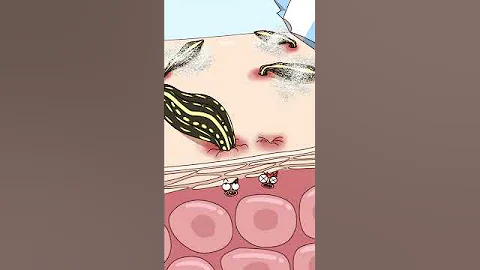 水蛭钻进去怎么取出来？How do you get leeches out? - 天天要闻