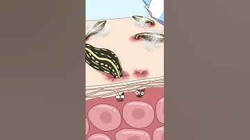 Thumbnail of 水蛭钻进去怎么取出来？How do you get leeches out?