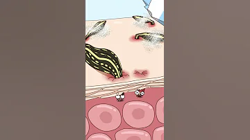 水蛭钻进去怎么取出来 How Do You Get Leeches Out 