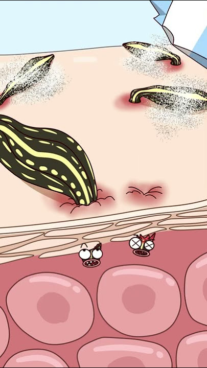 水蛭钻进去怎么取出来？How do you get leeches out?