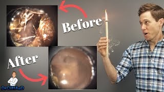 Do Ear Candles Work To Remove Earwax? | Ear Candling Proof!