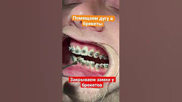 После фиксации брекетов надо в них установить дугу и закрыть замки