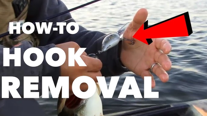 How to remove a fishing hook from your hand : Proven Method NO