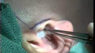 Surgical removal of a damaged temporomandibular joint disc