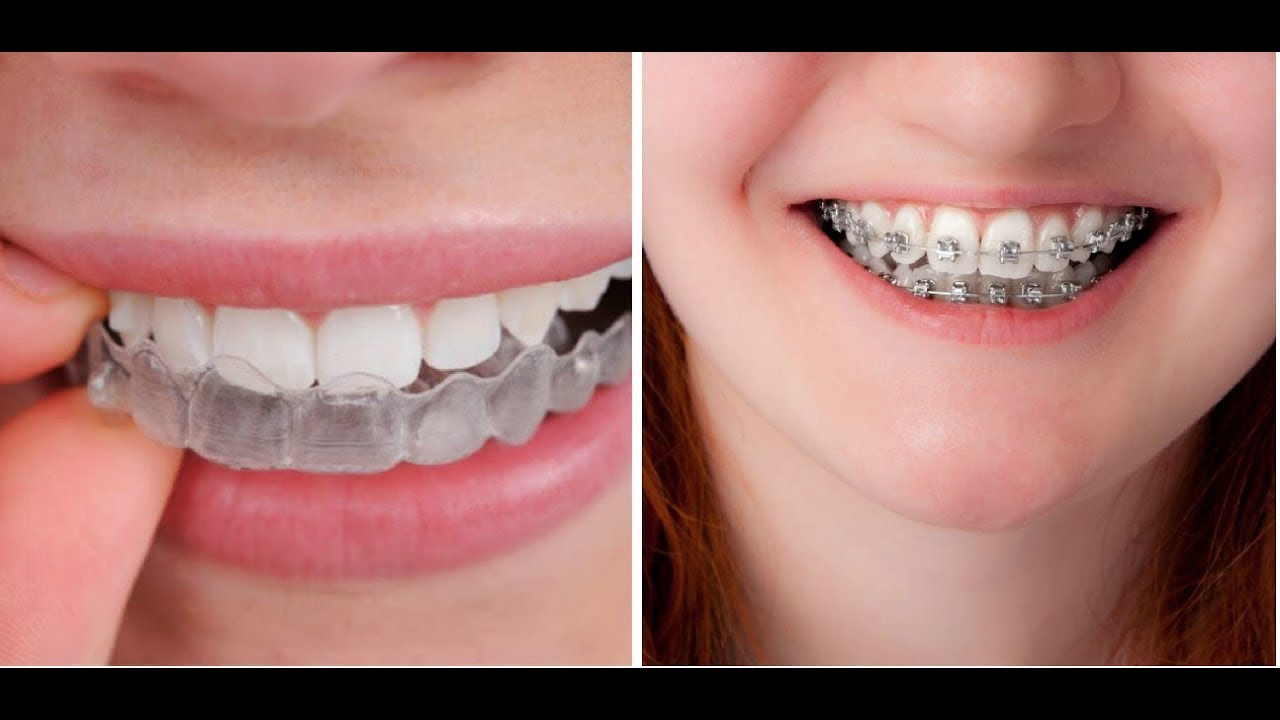 Braces VS Invisalign Which Is Better YouTube Braces VS Invisalign Which Is Better YouTube