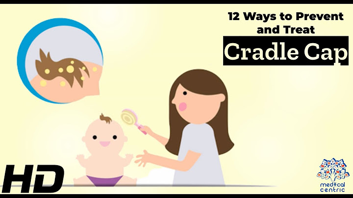 Cradle Cap Solutions: 12 Effective Ways to Prevent and Treat It