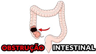 OBSTRUÇÃO INTESTINAL: O QUE É? QUAIS OS SINTOMAS E AS CAUSAS? QUAL É O TRATAMENTO?