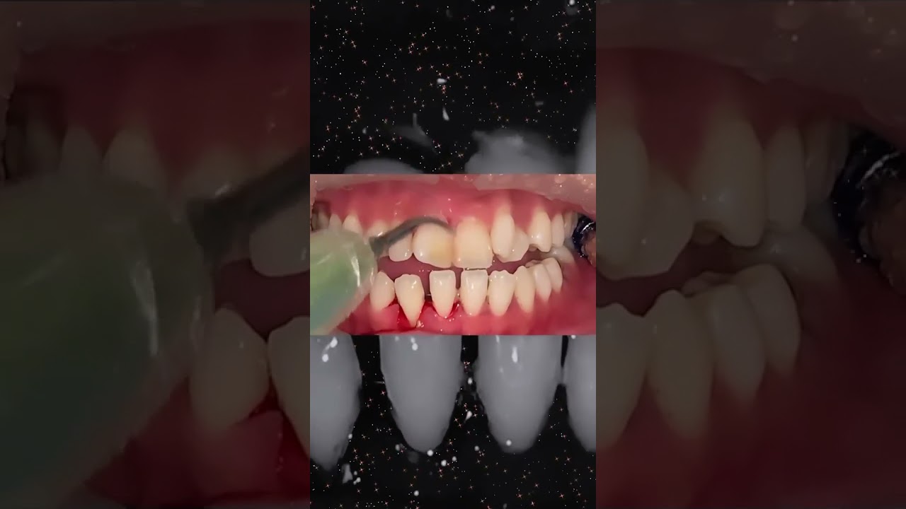 Satisfying teeth cleaning How frequently do you get i shorts YouTube