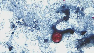 Cyclospora cases on the rise