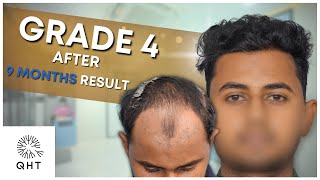 Hair Transplant in Kolkata | Best Results & Cost of Hair Transplant in Kolkata screenshot 2